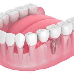 Illustration of single dental implant