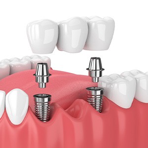 Illustration of implant bridge