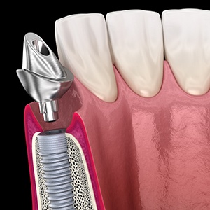 A 3D illustration of a dental implant’s abutment