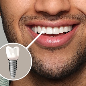 A closeup of a man’s smile that highlights his dental implant