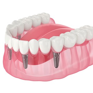 Illustration of implant denture
