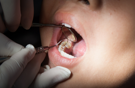 Dentist examining patients mouth with mirror
