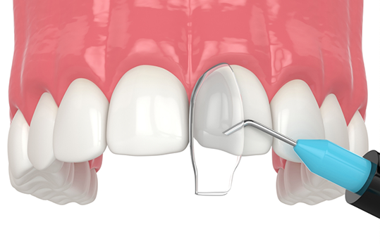 Illustration of teeth receiving cosmetic bonding