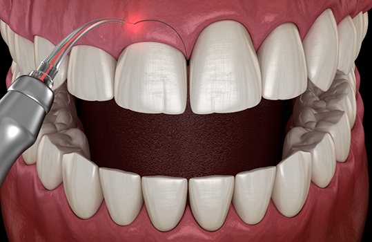 Illustration of laser being used to perform gum recontouring