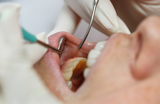 Close up of mouth being treated with dental laser