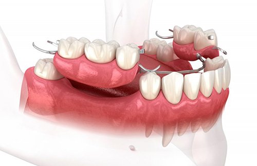 Illustration of partial denture
