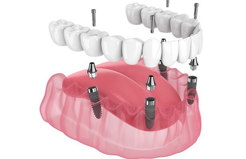 Exploded illustration of implant dentures