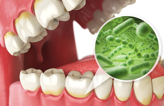 Illustration of bacteria hiding in gum tissue