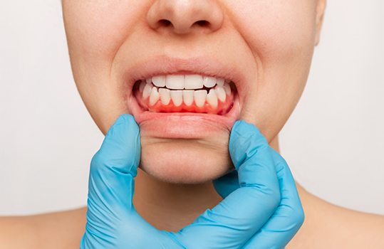 Gloved hand pulling down lips to show signs of gum disease