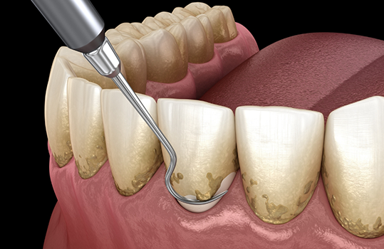 Illustration of scaling and root planing being performed on lower teeth