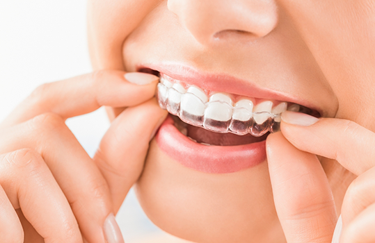 Close up of teeth with Invisalign clear aligner being put in
