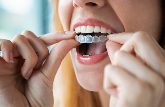 Blonde woman about to wear an Invisalign clear aligner