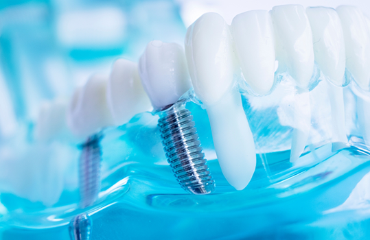Close up of dental implants in plastic tray