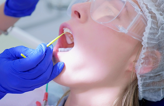 Close up of fluoride being applied to patients teeth