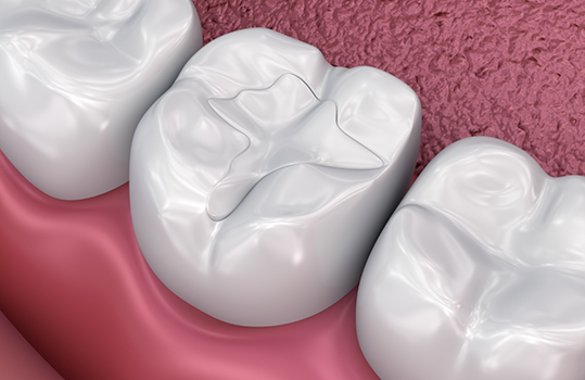 Illustration of teeth with tooth-colored fillings